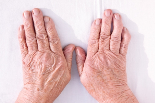 Rheumatoid arthritis and skin pr...