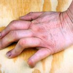 Rheumatoid arthritis vs. lupus: Causes, symptoms, risk factors, and complications