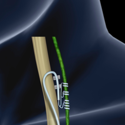 IBD inflammation can be controll...