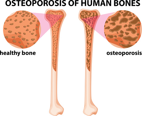 Gaps in osteoporosis treatment u...