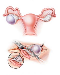 Home-remedies-for-ovarian-cysts