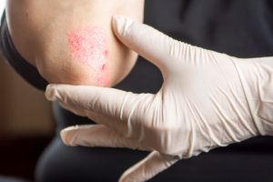 Home remedies for psoriasis