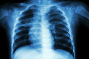 New treatment discovered for COPD and other lung diseases
