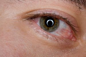 how to get rid of blood shot eyes