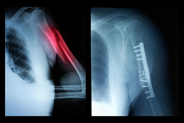 Humerus fracture: Types, causes,...