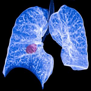 Nasal swab may be useful in confirming lung cancer diagnosis