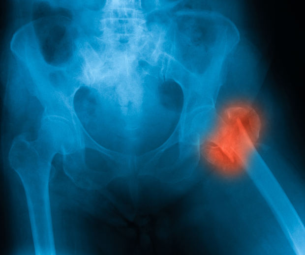 Risk of death linked to hip frac...