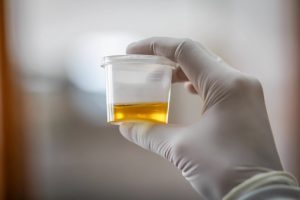 Urine-specific-gravity-test
