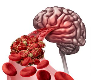 What causes blood clots in the brain
