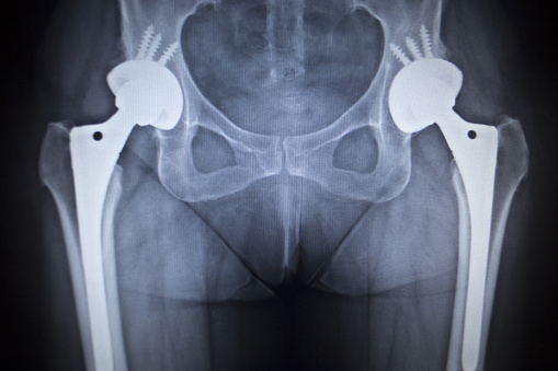 Total hip replacement improves f...