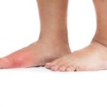 14 natural remedies for gout pain relief