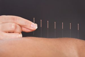 acupuncture dry needle for hip pain