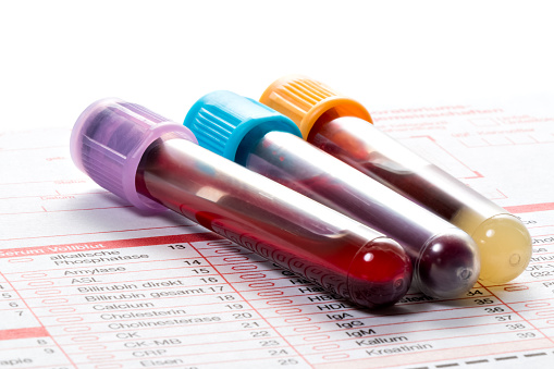 Lactate dehydrogenase (LDH) test...