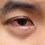 What causes mucus in eye (eye discharge) and how to get rid of it?