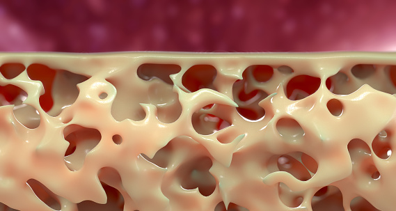 Can osteoporosis be reversed? 12...