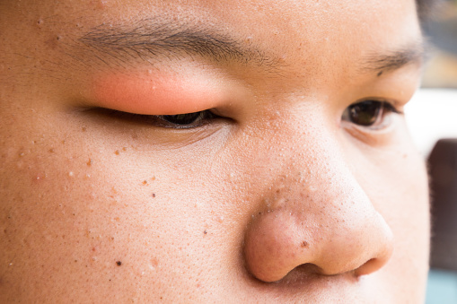 Periorbital Edema Causes Symptoms And Treatment