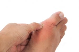 Purine-rich foods: Foods to avoid to reduce the risk of gout