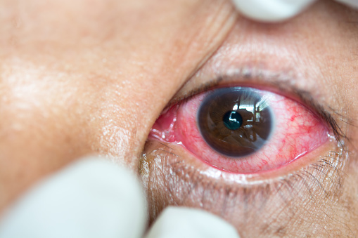 Shingles in the eye (herpes zost...