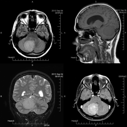 Vaccine-chemotherapy combo shows...