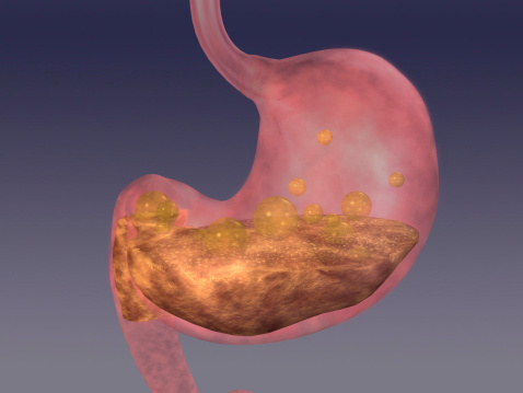 What causes antral gastritis