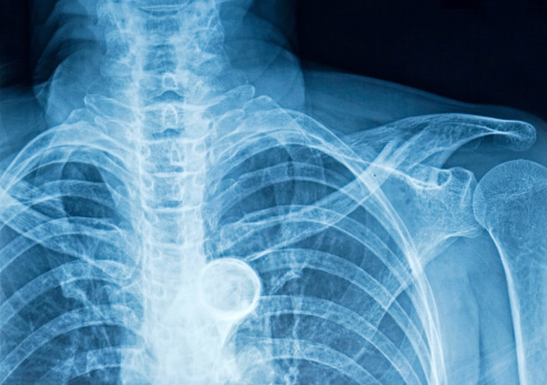 Bruised ribs: symptoms, causes, and natural remedies