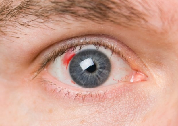 Blood clot in the eye and how to...