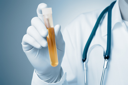 Crystals in urine: Know the caus...