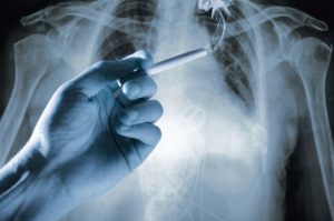Recent study shows that women need less frequent screening for lung cancer