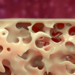 natural ways to treat osteoporosis