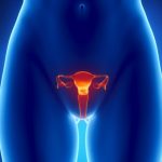 PCOS natural treatment: How to cure polycystic ovarian syndrome?