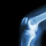 Infectious (septic) arthritis: Causes, complications, and treatment tips