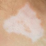 Can a gluten-free diet cure vitiligo?