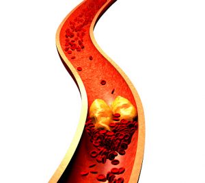 Increased thyroid hormone levels may be tied to atherosclerosis
