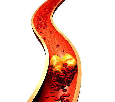 Atherosclerosis update: Preventi...
