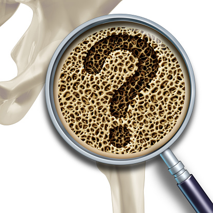 Osteopenia vs. osteoporosis: Und...