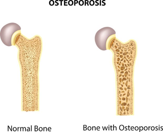 Osteoporosis: Causes, symptoms, ...
