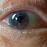 prevent-cataracts-naturally-home-remedies