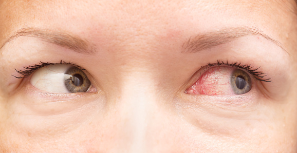 Red veins in eyes: Causes and tr...