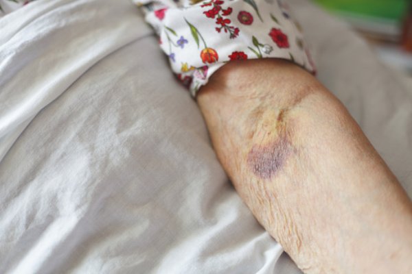 What is senile purpura? Causes, ...