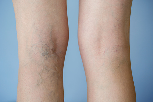 Varicose veins update: Causes, n...