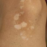 Vitiligo may increase thyroid disease risk, new vitiligo treatment may help