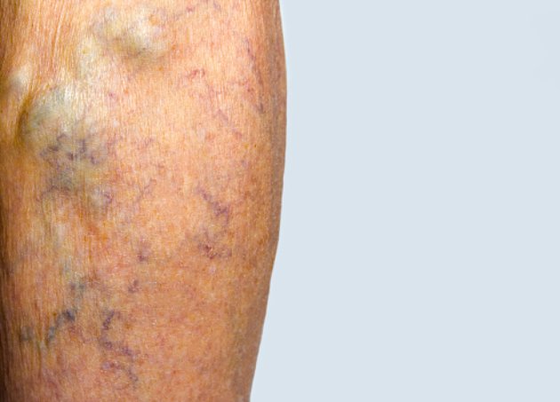 Are your unsightly veins dangerous?