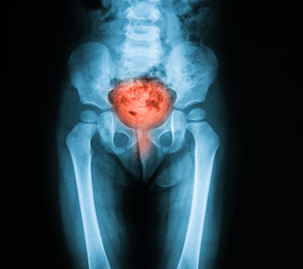 bladder enlarged causes symptoms health