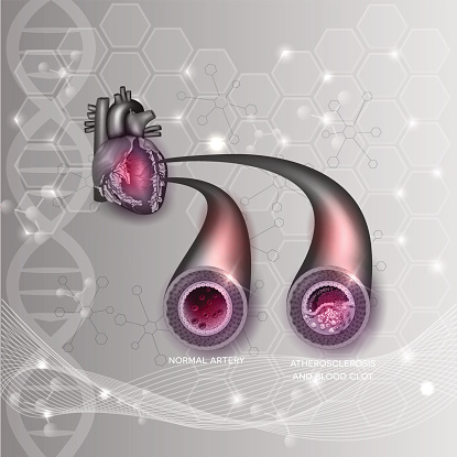 Restenosis: Causes, treatment, a...