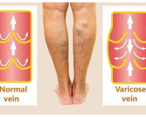 exercises for varicose veins)