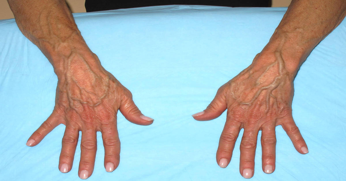 Sudden bulging veins in hands: Causes, symptoms, and treatment