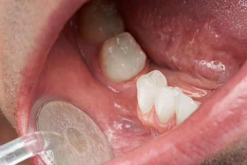 Gum disease found to increase ca...