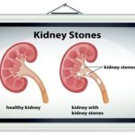 kidney stones linked to higher risk of chronic kidney disease