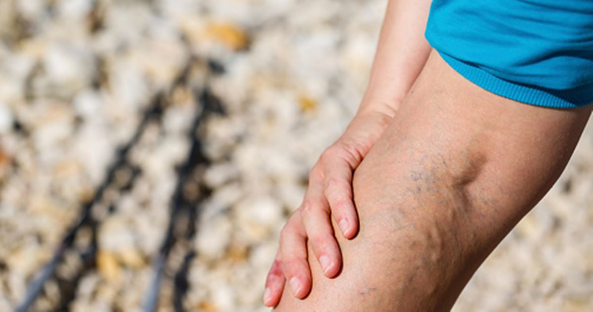 Vein Pain Common Causes and How to Treat Painful Veins?