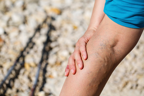 Vein pain: What causes painful v...